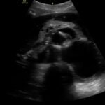 Aortic Dissection Case Report 4 Creative Commons images