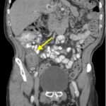 Imaging Findings of Small Bowel - Diverticulitis: A Case Report 6 Creative Commons images