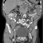 Imaging Findings of Small Bowel - Diverticulitis: A Case Report 5 Creative Commons images