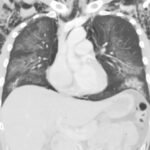 Electronic Cigarette or Vaping-Associated Lung Injury Case Report 1 Creative Commons images