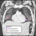 Electronic Cigarette or Vaping-Associated Lung Injury Case Report 4 Creative Commons images