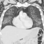 Electronic Cigarette or Vaping-Associated Lung Injury Case Report 3 Creative Commons images