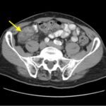Imaging Findings of Small Bowel - Diverticulitis: A Case Report 8 Creative Commons images