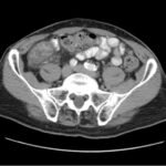 Imaging Findings of Small Bowel - Diverticulitis: A Case Report 7 Creative Commons images