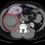 R Retroperitoneal Hematoma CT Annotated 2. JETem 2023