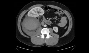 R Retroperitoneal Hematoma CT Unannotated 2. JETem 2023