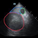R Retroperitoneal Hematoma US 1 Annotated 2. JETem 2023