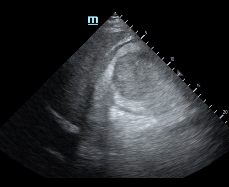 R Retroperitoneal Hematoma US 1 Unannotated. JETem 2023