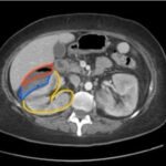 Emphysematous pyelonephritis. CT Transverse Annotated. JETem 2023