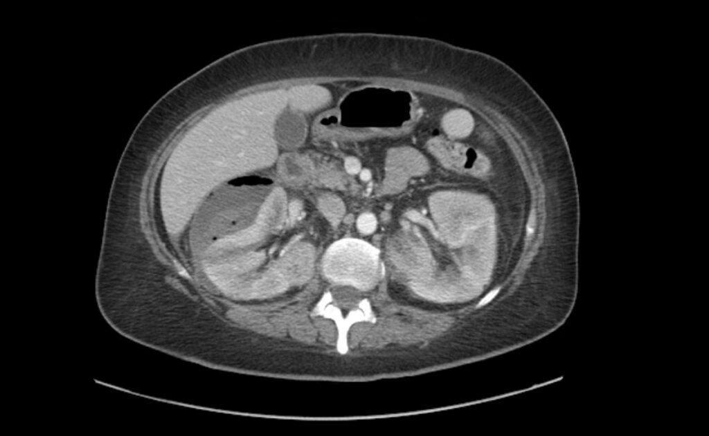 Subtalar Dislocation Jetem