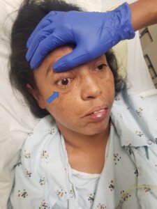 Mucormycosis. Photograph 1 Annotated. JETem 2023
