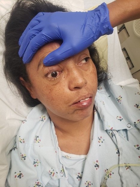 Mucormycosis. Photograph 2. JETem 2023