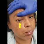 Mucormycosis. Photograph 3. Annotated. JETem 2023