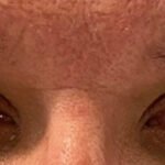 Internuclear Ophthalmoplegia. Eyes Center Annotated. JETem 2024