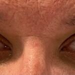 Internuclear Ophthalmoplegia. Eyes Center Unannotated. JETem 2024