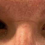 Internuclear Ophthalmoplegia. Eyes Left Annotated. JETem 2024