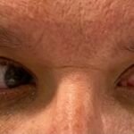 Internuclear Ophthalmoplegia. Eyes Left Unannotated. JETem 2024