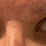 Internuclear Ophthalmoplegia. Eyes Right Annotated. JETem 2024