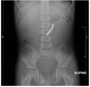 Point Of Care Ultrasound Use for Detection of Multiple Metallic Foreign Body Ingestion. KUB. JETem 2023
