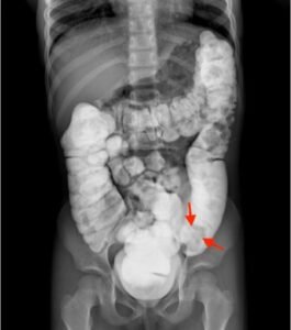 Colocolic Intussusception. Contrast Enema Annotated. JETem 2024