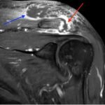 Septic Arthritis of AC Joint. MRI Coronal. Annotated. JETem 2024