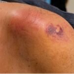 Septic Arthritis of AC Joint. Shoulder Photo Close. JETem 2024