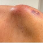 Septic Arthritis of AC Joint. Shoulder Photo Far. JETem 2024