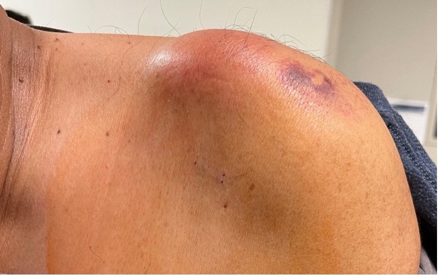 Septic Arthritis of AC Joint. Shoulder Photo Far. JETem 2024