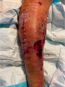 Acute Compartment Syndrome. Photo Post Fasciotomy. JETem 2024