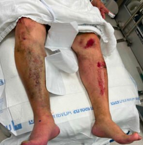 Acute Compartment Syndrome. Photo Pre Fasciotomy. JETem 2024