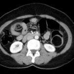 Adult Intussusception. CT Axial Unannotated. JETem 2024