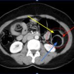 Adult Intussusception. CT Axial annotated. JETem 2024