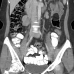 Adult Intussusception. CT Coronal Unannotated. JETem 2024