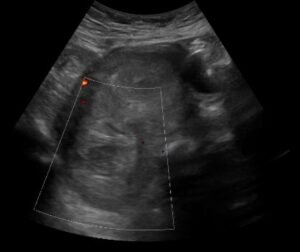 Iatrogenic Uterine Perforation. US Unannotated. JETem 2024