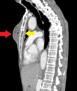 Chest wall abscess CT sagittal annotated. JETem 2024