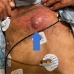 Chest wall abscess. Photograph annotated. JETem 2024