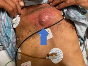 Chest wall abscess. Photograph annotated. JETem 2024