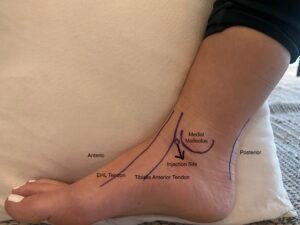 Subtalar Dislocation. Personal Injection. JETem 2024