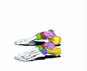 Subtalar Dislocation. Subtalar Dislocation. Bones JPEG. JETem 2024