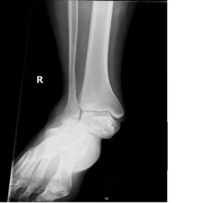 Subtalar Dislocation. Subtalar dislocation AP unannotated. JETem 2024