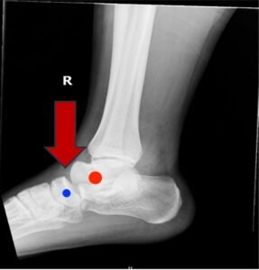 Subtalar Dislocation. Subtalar dislocation lateral annotated. JETem 2024