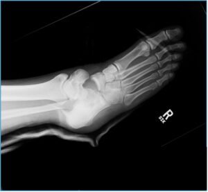 Subtalar Dislocation. sp manipulation unannotated. JETem 2024