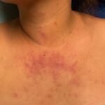 Dermatomyositis Chest. JETem 2024