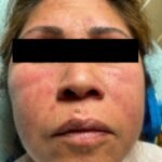 Dermatomyositis Face. JETem 2024