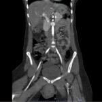 Vulvar Hematoma. CT Coronal Unannotated. JETem 2024