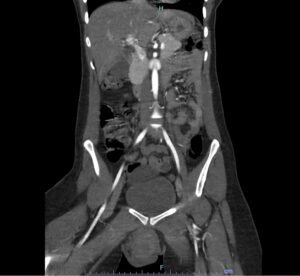 Vulvar Hematoma. CT Coronal Unannotated. JETem 2024