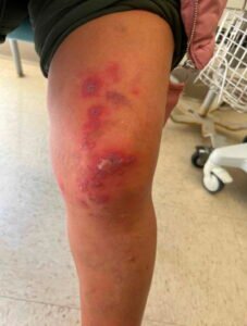 Erythema Multiforme. Knee. JETem 2025