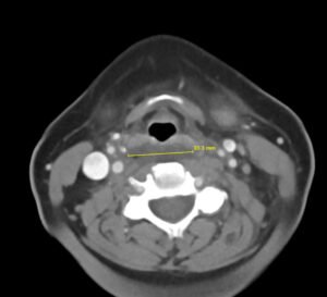 RPA Neck. CT Axial. Annotated. JETem 2025