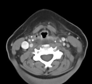 RPA Neck. CT Axial. Unannotated. JETem 2025
