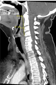 RPA Neck. CT Lateral. Annotated. JETem 2025
